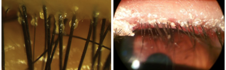 blefarite crostas e demodex