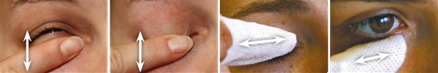 Blefarite massagem palpebral