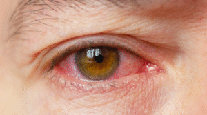 A conjuntivite é uma inflamação da conjuntiva, a membrana fina e transparente que recobre a parte branca dos olhos (esclera) e o interior das pálpebras.