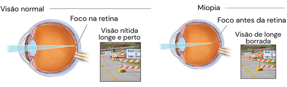 miopia o que é