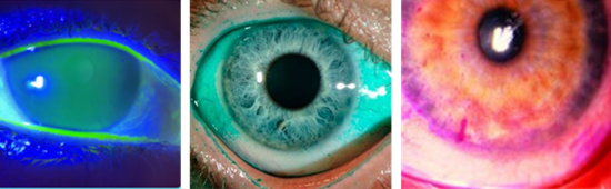 colorações da superfície ocular