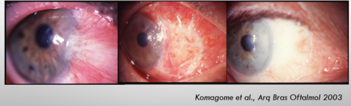 cirurgia de pterigio