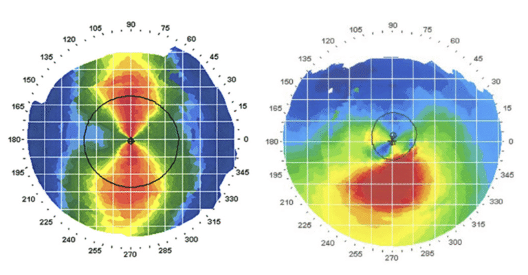 Topografia com astigamtismo e com ceratocone ceratocone